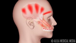 Trastornos de ATM articulación temporomandibular ¿Qué síntomas y tratamientos existen [upl. by Sirkin]