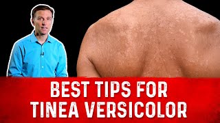 Best Tips for Tinea Versicolor Treatment Skin Fungus – Dr Berg [upl. by Akinam]