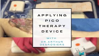 DrArthurMiami applying the PICO negative pressure wound therapy device [upl. by Kiona]