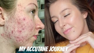 MY ISOTRETINOIN ACCUTANE JOURNEY  BEFORE AND AFTER PHOTOS [upl. by Herwin927]