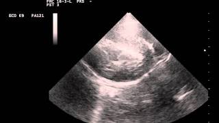 cardiomegaly and hypertrophy due to an adrenal pheochromocytomaavi [upl. by Jeannette733]