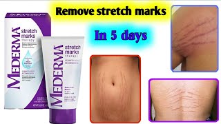 Mederma stretch marks therapy cream  Review  Remove stretch marks [upl. by Mauro]