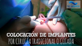 Colocación de implantes dentales [upl. by Ulrika23]