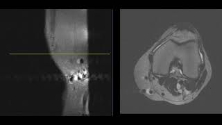 3 findings in 46 year old knee [upl. by Ijan]