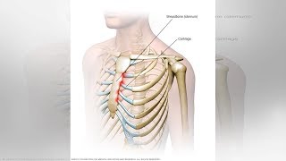 What You Need to Know About Tietze Syndrome  Tita TV [upl. by Esilegna895]