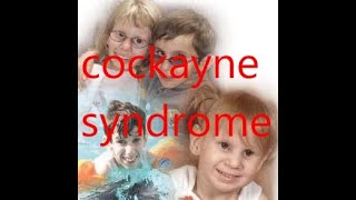 cockayne syndrome [upl. by Hagi]