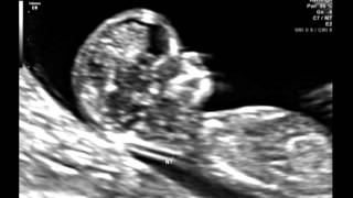 Ultrasound Video Part One 12 Weeks amp 2 Days Its a girl 101512 [upl. by Eloise116]