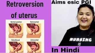 Retroversion of uterus Degrees of retroversion For medical students in Hindi [upl. by Auoz]