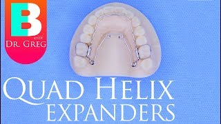 Quad Helix Expander for Braces  Invisalign [upl. by Josi498]