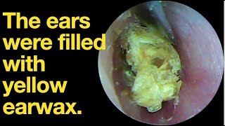 The ears were filled with yellow earwaxear wax removal  ear cleaning  ASMR  relaxation  relax [upl. by Nirual635]