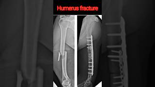 Humerus fracturevairalvideo anatomy radiological [upl. by Arihs]