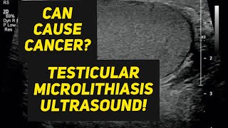 Testicular microlithiasis ultrasound [upl. by Norak]