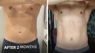 SculpSure Before amp After 1 session [upl. by Eidualc]