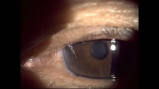 left eye trichiasis Sun Valley Eye Care Chandler AZ 85224 [upl. by Whitebook]