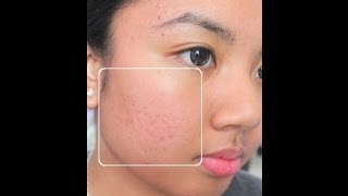 Get Rid of Acne Scars by Using Home Remedies  Tips For Getting Rid of Acne Scars [upl. by Enaenaj]