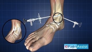 Ankle ArthroscopyDiagnostic Procedure [upl. by Eesac]