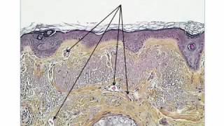 2 new dermoscopic criteria for LMM on the face by Dr Luc Thomas [upl. by Davie492]