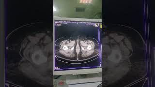 Chronic calcular cholecystitis [upl. by Alaekim]