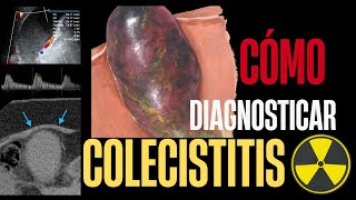 COLECISTITIS  HALLAZGOS POR IMAGEN  USGTACRMHIDA [upl. by Rosabelle]