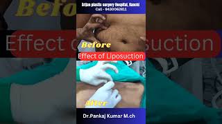 Result of laser liposuction to Remove body fat laser liposuction shorts liposuction [upl. by Reimer]