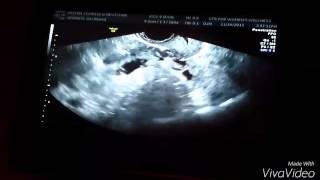 6w4d miscarriage ultrasound [upl. by Trinidad]