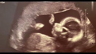 Anomaly Scan Full Video  Full Anatomy Scan at 21 Weeks [upl. by Ruffina]