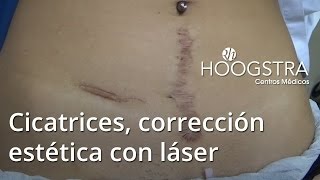 Cicatrices corrección estética con láser 15042 [upl. by Akena]