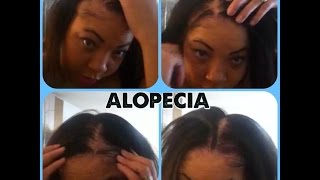 ALOPECIA Hair loss Ovarian Cyst sufferer No edges MY STORY with pictures [upl. by Claudy]