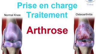 Traitement de lArthrose douleur cervicale du genou How to treat osteoarthritis [upl. by Jerome]