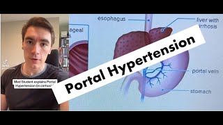 COMPLICATIONS of Portal Hypertension EXPLAINED [upl. by Suiramad504]