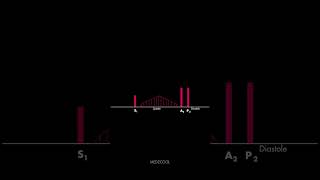 Atrial Septal Defect Heart Sound [upl. by Daegal]