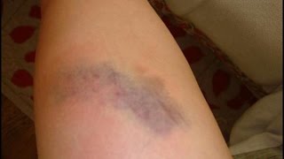 ¿Cómo quitar moretones o hematoma [upl. by Temhem560]