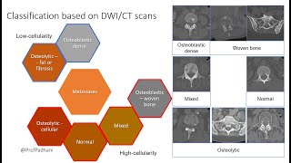 Multiparametric Imaging Patterns of Untreated Bone Metastases [upl. by Anattar]