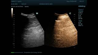 Hemangioma 29 CEUS [upl. by Ettenuj294]