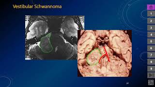 Posterior Fossa Masses [upl. by Etnohs]