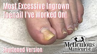 Most Extreme Ingrown Toenail Salon Pedicure  Shortened [upl. by Hploda]