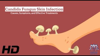 Candida Fungus Skin Infection Explained What You Need to Know [upl. by Hazard952]