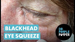 Blackhead Eye Squeeze [upl. by Nikolia353]