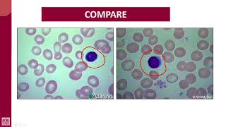 Hematology  1  U6L4  PBS of megaloblastic anaemia [upl. by Arracot]