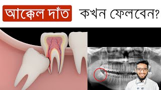 ব্যাথা না থাকলেও আক্কেল দাঁত কখন ফেলতে হয় Reasons for Wisdom tooth Extraction even you are painless [upl. by Frasier]