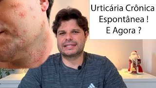 Urticária Crônica Espontânea o que fazer [upl. by Aramois730]