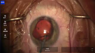 Explant ICL removal  Staar Surgical  Eye Centers of Tennessee [upl. by Attebasile]