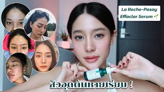 ใช้หมดใช้จริง ที่สุดของเซรั่มลดสิวอุดตันLaroche Posay Effaclar Serum✨  widpim withpim [upl. by Franciskus]