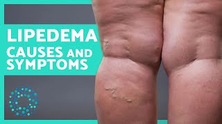 SIGNS You Suffer from LIPEDEMA 🦵🏼 Possible Causes and Treatments [upl. by Cookie676]