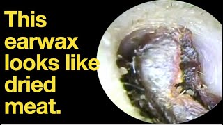 This earwax looks like dried meatear wax removal  ear cleaning  ASMR  relaxation  relax [upl. by Olenka]