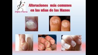 Anomalías de las uñas de las manos [upl. by Asiole]