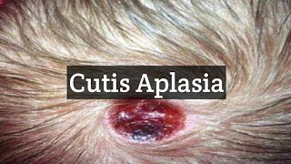 Cutis Aplasia  A skin Condition With Missing Skin Areas [upl. by Arret]