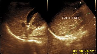 Chronic Liver Parenchymal Disease  Cirrhosis  Chronic Hepatitis [upl. by Fabyola]