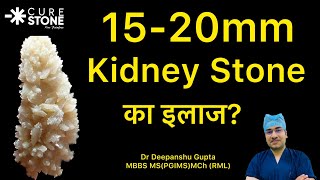 1520mm Kidney Stone का इलाज कैसे होता है Treatment for 1520 mm Kidney stones In Hindi [upl. by Ahsrop]