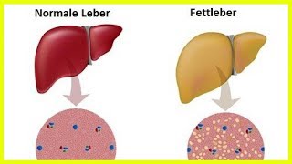 Fettleber – Was kann ich tun [upl. by Schwerin]